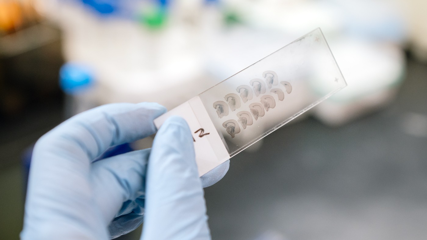 A new study by researchers at Gladstone and UCSF has identified FDA-approved cancer drugs that reverse the gene expression signatures associated with Alzheimer’s disease.